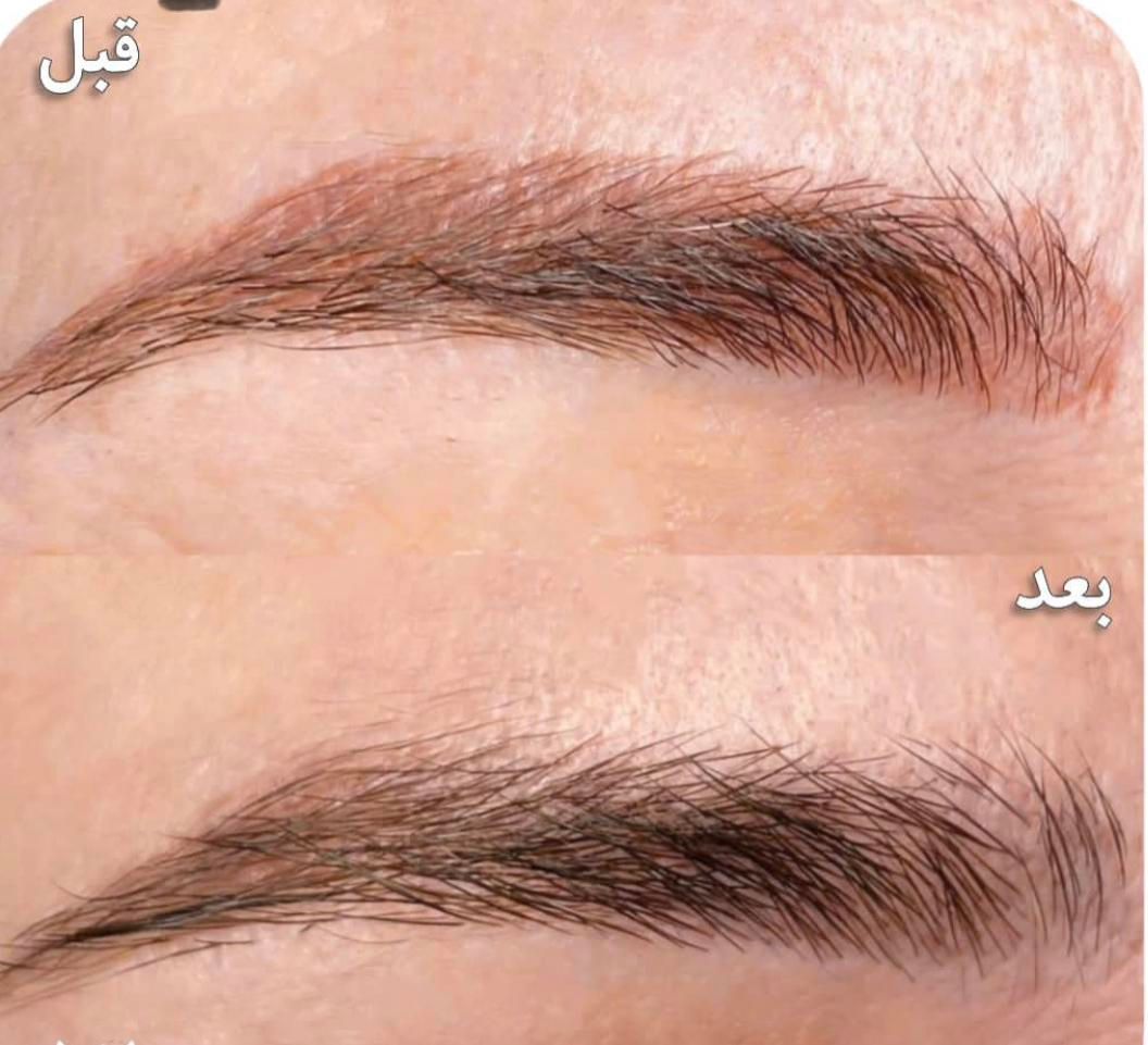 پاک کردن انواع تتو رنگی خالکوبی صورت وبدن بالیزر|خدمات آرایشگری و زیبایی|یاسوج, |دیوار
