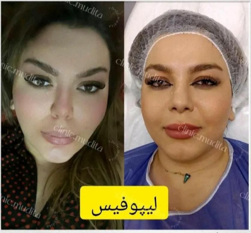 بوکالفت/ساکشن غبغب/ساکشن شکم/تزریق چربی باسن/فیلر|خدمات آرایشگری و زیبایی|تهران, صادقیه|دیوار