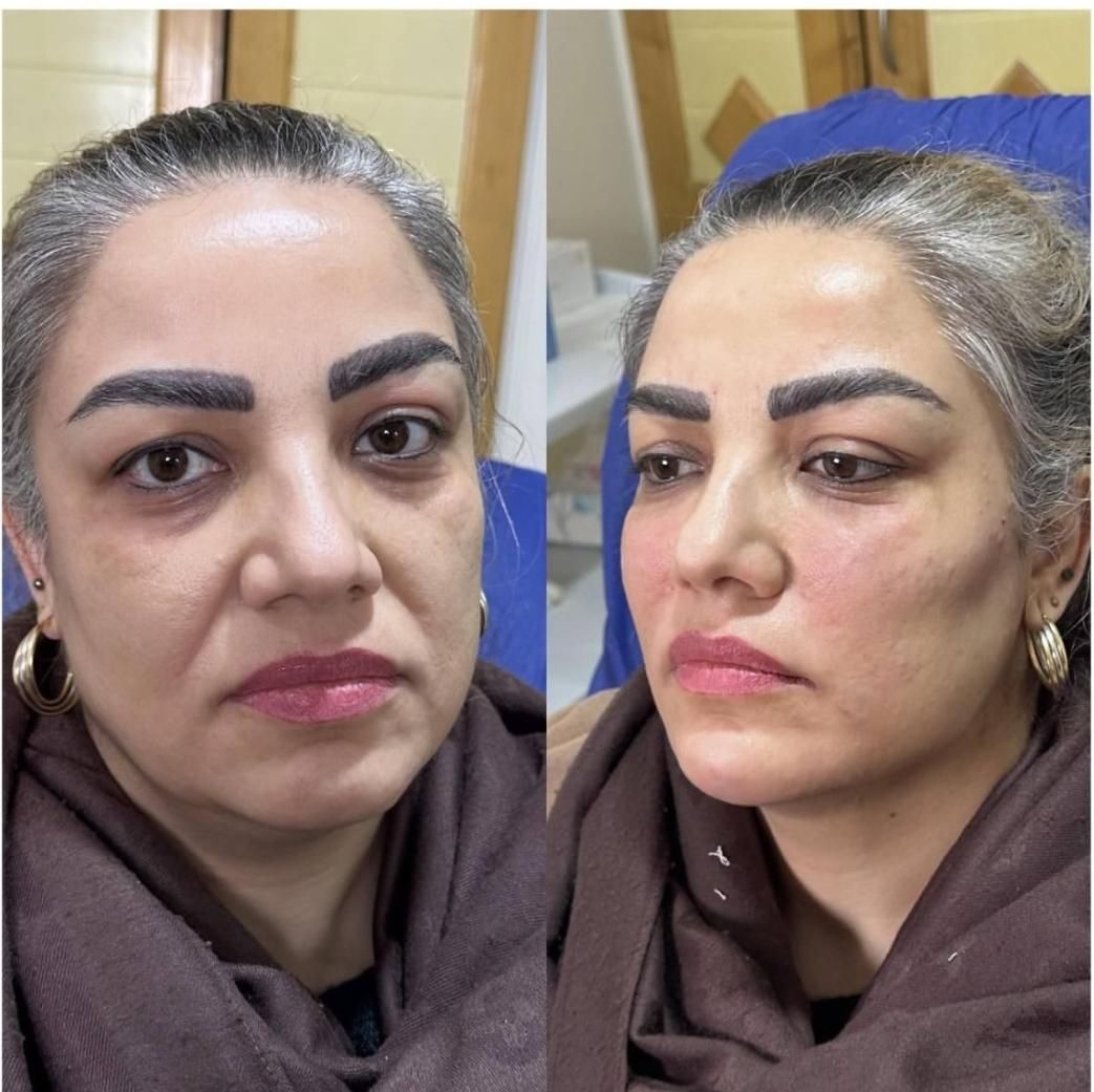 جشنوراه اقساطی ژل و بوتاکس با ضمانت بی قید و شرط|خدمات آرایشگری و زیبایی|تهران, میرداماد|دیوار