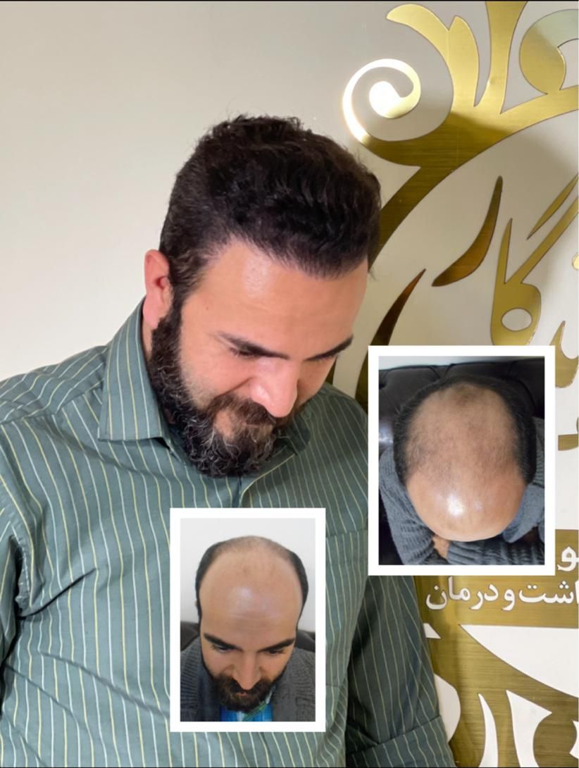 کاشت مو ، تراکم بالا خط رویش طبیعی تضمینی|خدمات آرایشگری و زیبایی|تهران, عباس‌آباد|دیوار