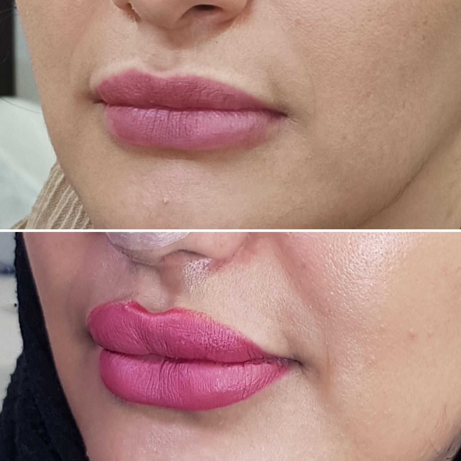 بوتاکس ژل فیلر مزوتراپی لیزر هایفو لیفت نخ در مطب|خدمات آرایشگری و زیبایی|اصفهان, مسجد مصلی|دیوار