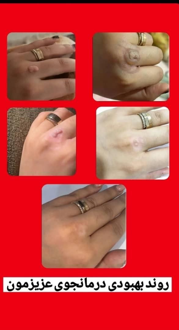 برطرف کردن زگیل و تبخال تناسلی بصورت ریشه ای|آرایشی، بهداشتی، درمانی|مشهد, دانشگاه فردوسی|دیوار
