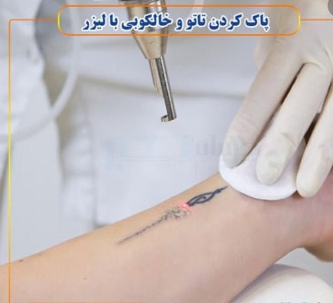 پاک‌کردن تتو با لیزر در استان یزد|خدمات آرایشگری و زیبایی|یزد, |دیوار