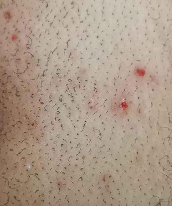 درمان زیگیل تناسلی HPV|خدمات آرایشگری و زیبایی|تهران, جردن|دیوار