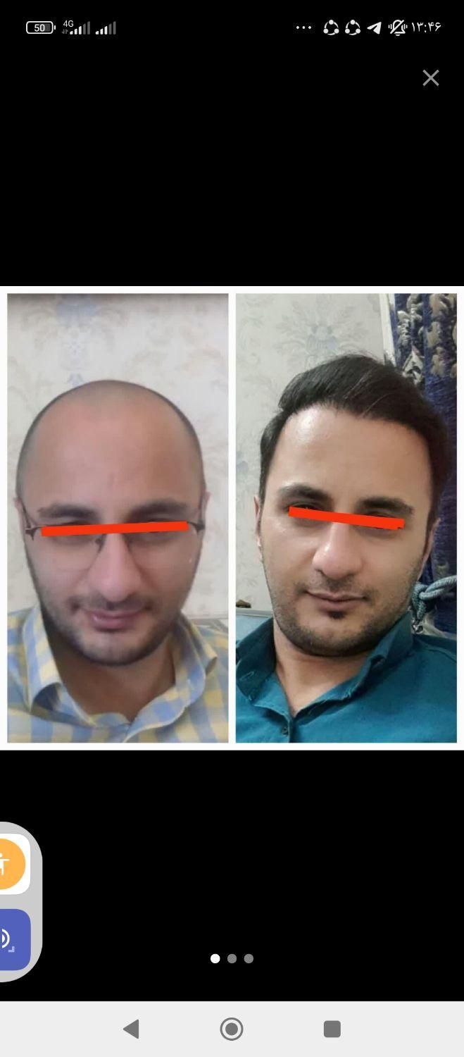 کاشت مو پرتراکم اقساطی با پرداخت 4میلیون تومان|خدمات آرایشگری و زیبایی|اصفهان, میرعماد|دیوار