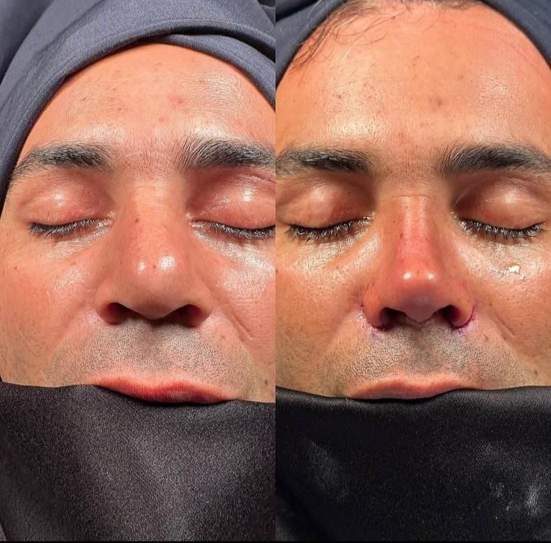 بلفاروپلاستی ،سانترال لب،لیفت ابرو،چربی صورت|خدمات آرایشگری و زیبایی|تهران, هروی|دیوار