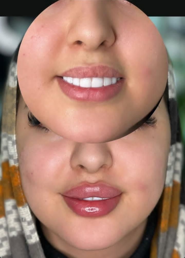 تزریق ژل و بوتاکس تخفیف بهاره ۳۹۹|خدمات آرایشگری و زیبایی|تهران, نازی‌آباد|دیوار