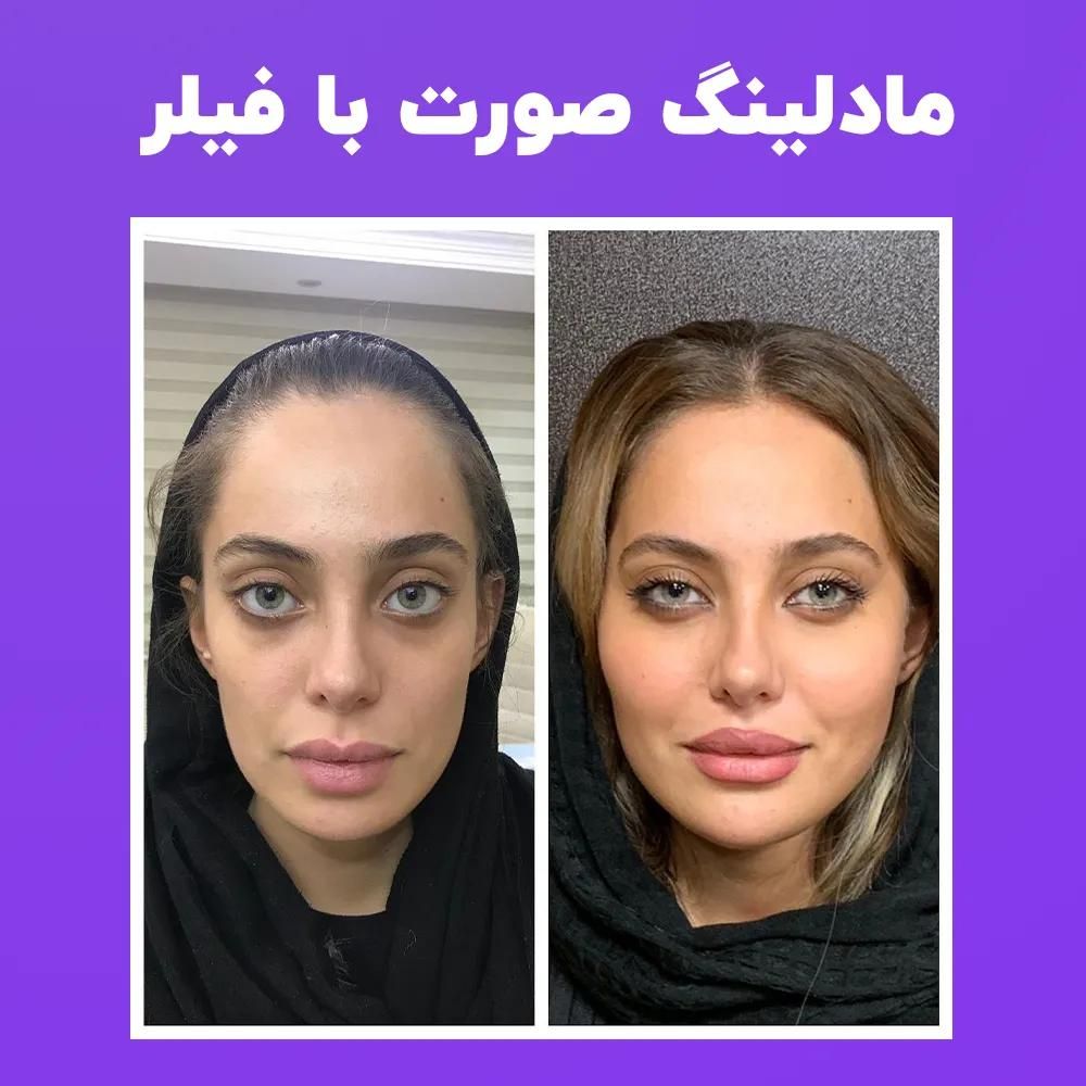 تزریق ژل بوتاکس لیزرمو مزو فیلرلب روسی لیفت صورت|خدمات آرایشگری و زیبایی|تهران, پونک|دیوار