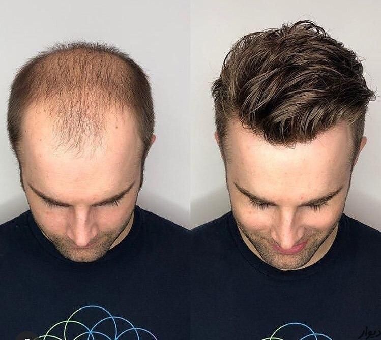 پروتز مو تخصص ماست|خدمات آرایشگری و زیبایی|تبریز, |دیوار