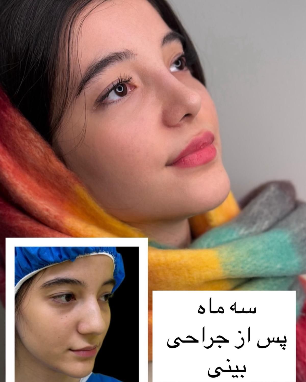 جراحی زیبائی بینی عمل بینی لیفت شقیقه پلک گوش غبغب|خدمات آرایشگری و زیبایی|اصفهان, مرداویج|دیوار