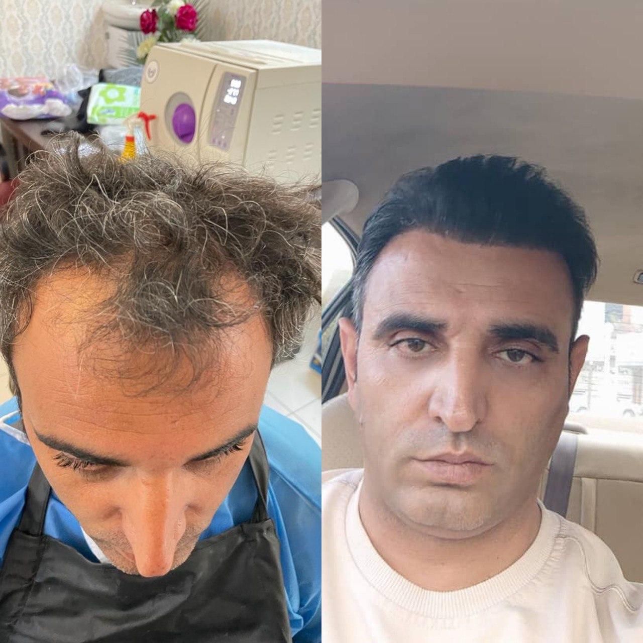 جشنواره کاشت مو ریش و ابرو|خدمات آرایشگری و زیبایی|مراغه, |دیوار