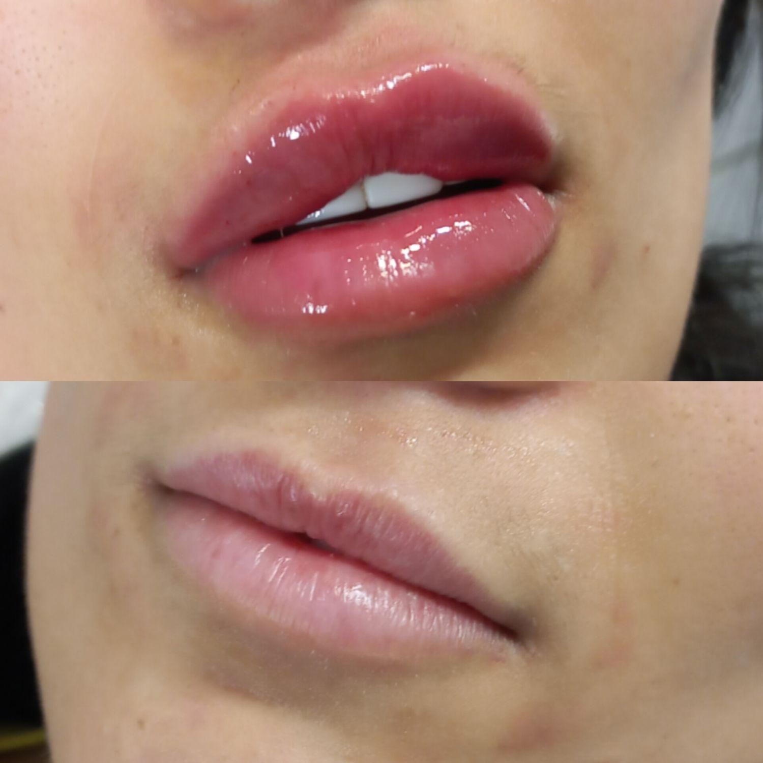 تزریق ژل لب و بوتاکس(پک 10cc)،جوانسازی و فیشال|خدمات آرایشگری و زیبایی|تهران, مهران (سیدخندان)|دیوار