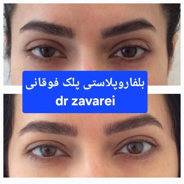 بلفاروپلاستی پلک فوقانی  بالیزر|خدمات آرایشگری و زیبایی|تهران, شهرک غرب|دیوار