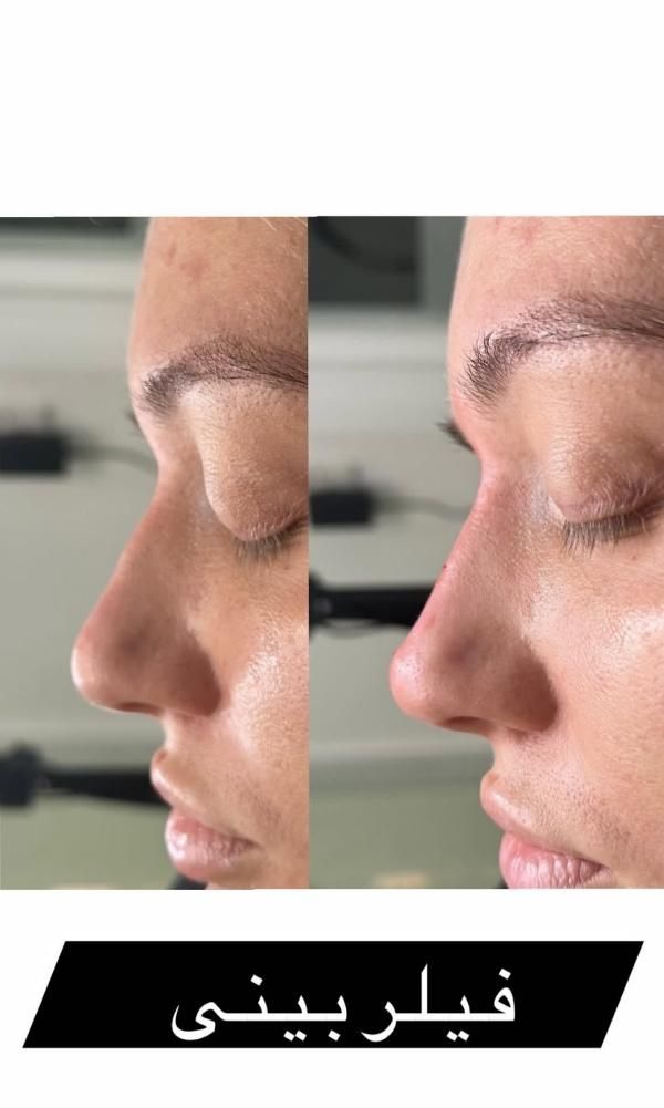 آموزش و انجام خدمات زیبایی ژل، بوتاکس ، آنزیم.مزو|خدمات آرایشگری و زیبایی|بروجرد, |دیوار