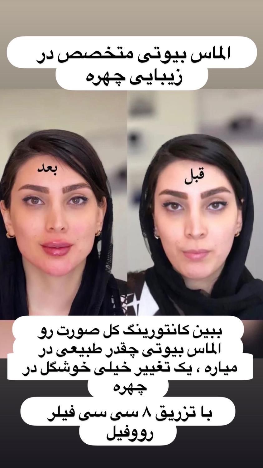 تزریق ژل بوتاکس لیفت نخ هایفو بلفاروپلاستی لیزر|خدمات آرایشگری و زیبایی|مشهد, کوه سنگی|دیوار