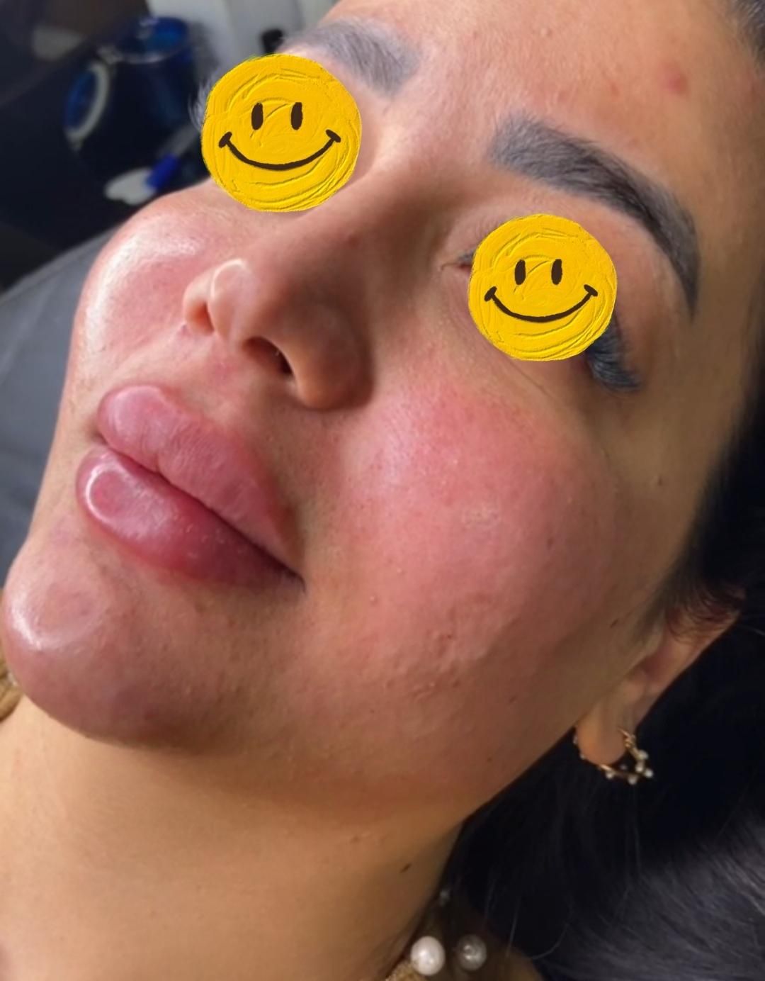 تزریق ژل فیلر بوتاکس مزوژل|خدمات آرایشگری و زیبایی|مشهد, طبرسی شمالی|دیوار