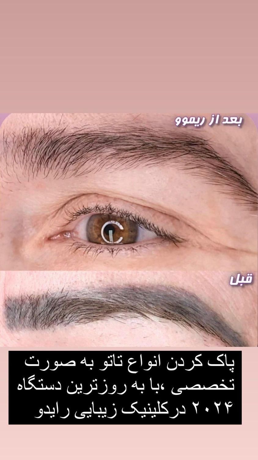 پاک کردن تاتو خالکوبی رنگی وقدیمی بالیزرکیوسوئیچ|خدمات آرایشگری و زیبایی|یاسوج, |دیوار