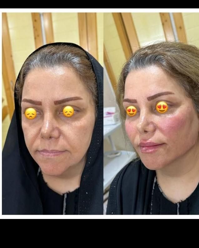 اموزش پزشک متخصص ژل.فیلر‌بوتاکس.لیفت نخ.ساکشن غبغب|خدمات آموزشی|مشهد, سناباد|دیوار