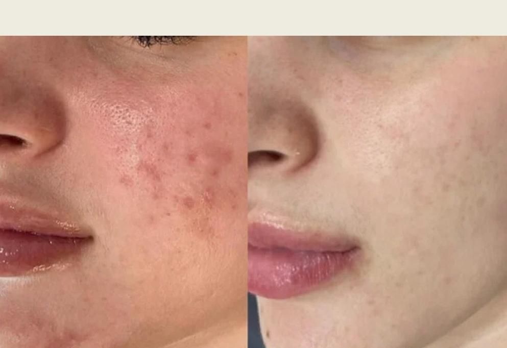 جوش و تیرگی صورت ، ریزش مو ، جوانسازی پوست|خدمات آرایشگری و زیبایی|رفسنجان, |دیوار