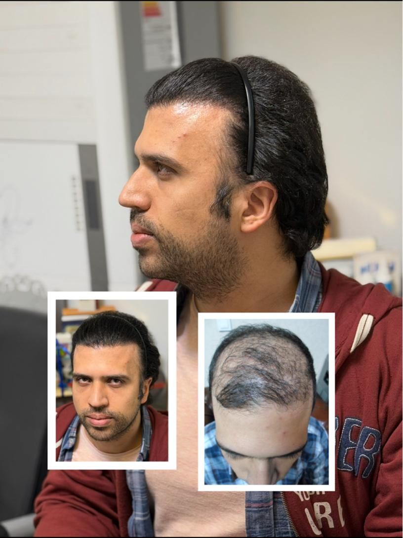 کاشت مو ، تراکم بالا خط رویش طبیعی تضمینی|خدمات آرایشگری و زیبایی|تهران, عباس‌آباد|دیوار
