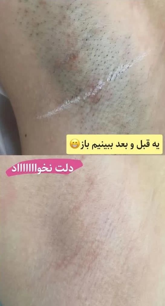 لیزر موهای زائد لیزر آقایان لیزر بانوان لیزر خانم|خدمات آرایشگری و زیبایی|اصفهان, سعادت‌آباد|دیوار