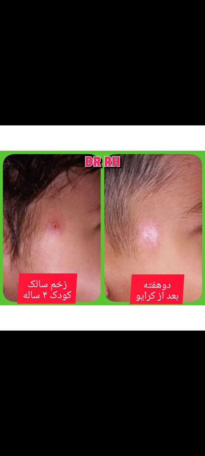 فریز زگیل میخچه/پزشک/بهارستان/خالبرداری|خدمات آرایشگری و زیبایی|اصفهان, بهارستان|دیوار