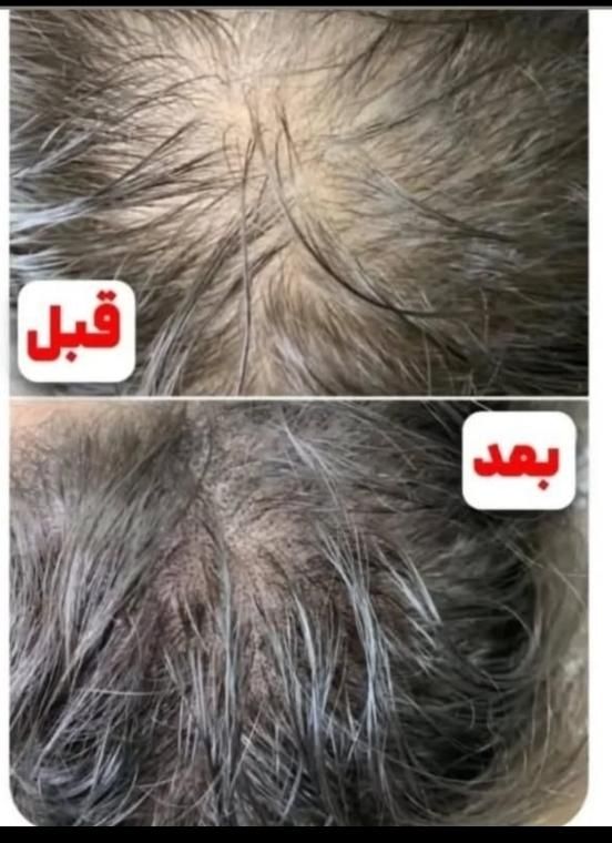(پی آر پی بدون درد) رشد مجدد مو ،  جوانسازی صورت|خدمات آرایشگری و زیبایی|اهواز, زیتون کارمندی|دیوار