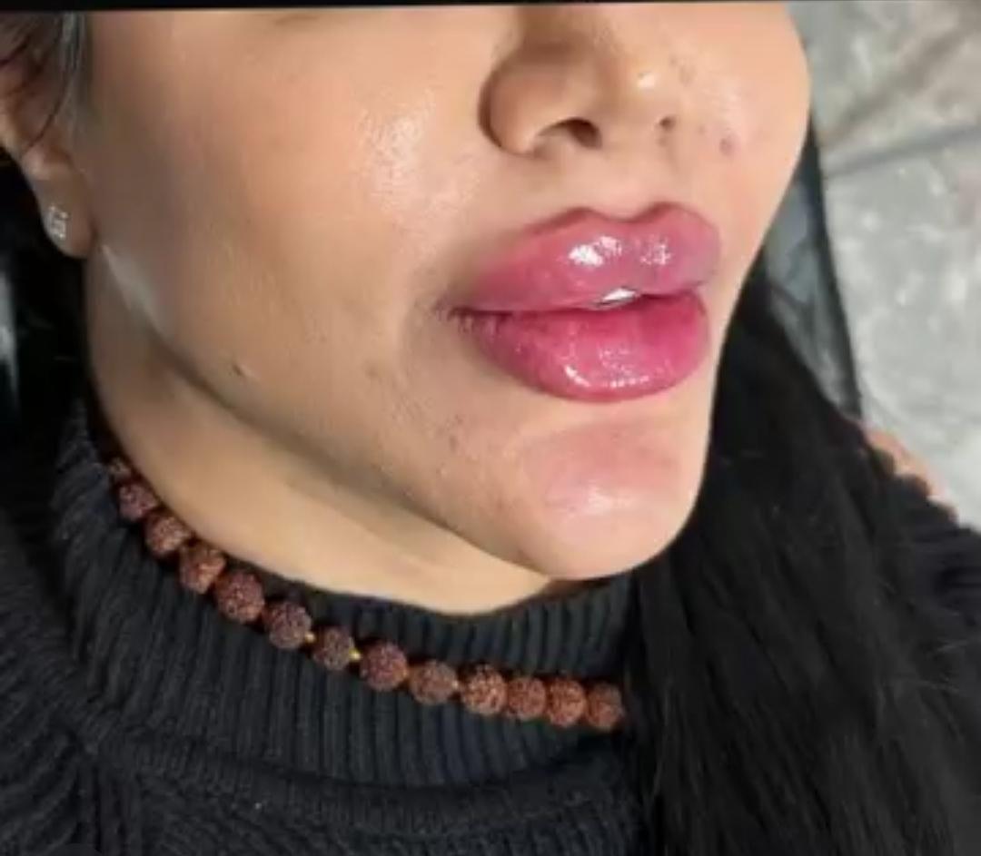 لیفت صورت با نخ. ژل.بوتاکس.مزوژل. درکلینیک|خدمات آرایشگری و زیبایی|کرمانشاه, |دیوار
