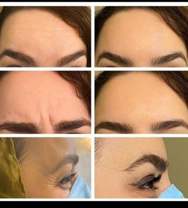 بوتاکس صورت و زیر بغل(جشنواره)در مطب|خدمات آرایشگری و زیبایی|اصفهان, ملک‌شهر|دیوار