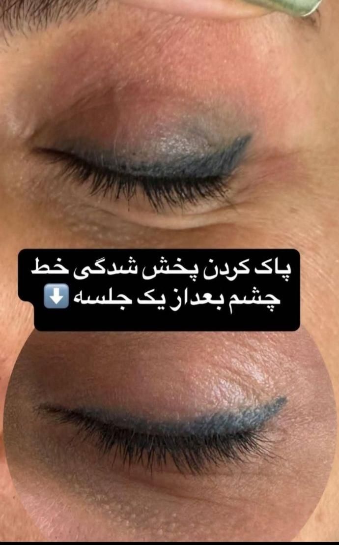 پاک کردن تتو ویژه اقایان وبانوان باجدیدترین دستگاه|خدمات آرایشگری و زیبایی|اهواز, نادری|دیوار