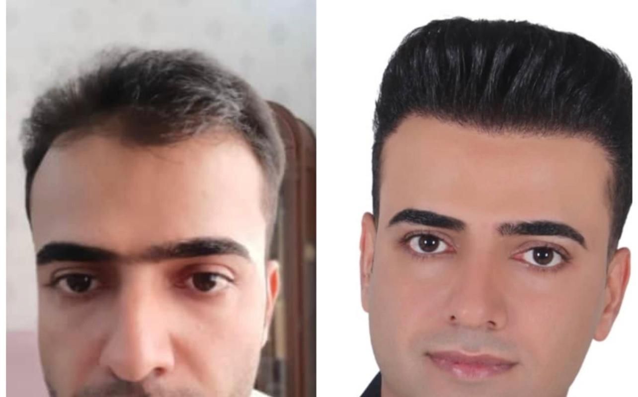 کاشت مو ب روش شیرازی درمشهد|خدمات آرایشگری و زیبایی|مشهد, احمدآباد|دیوار