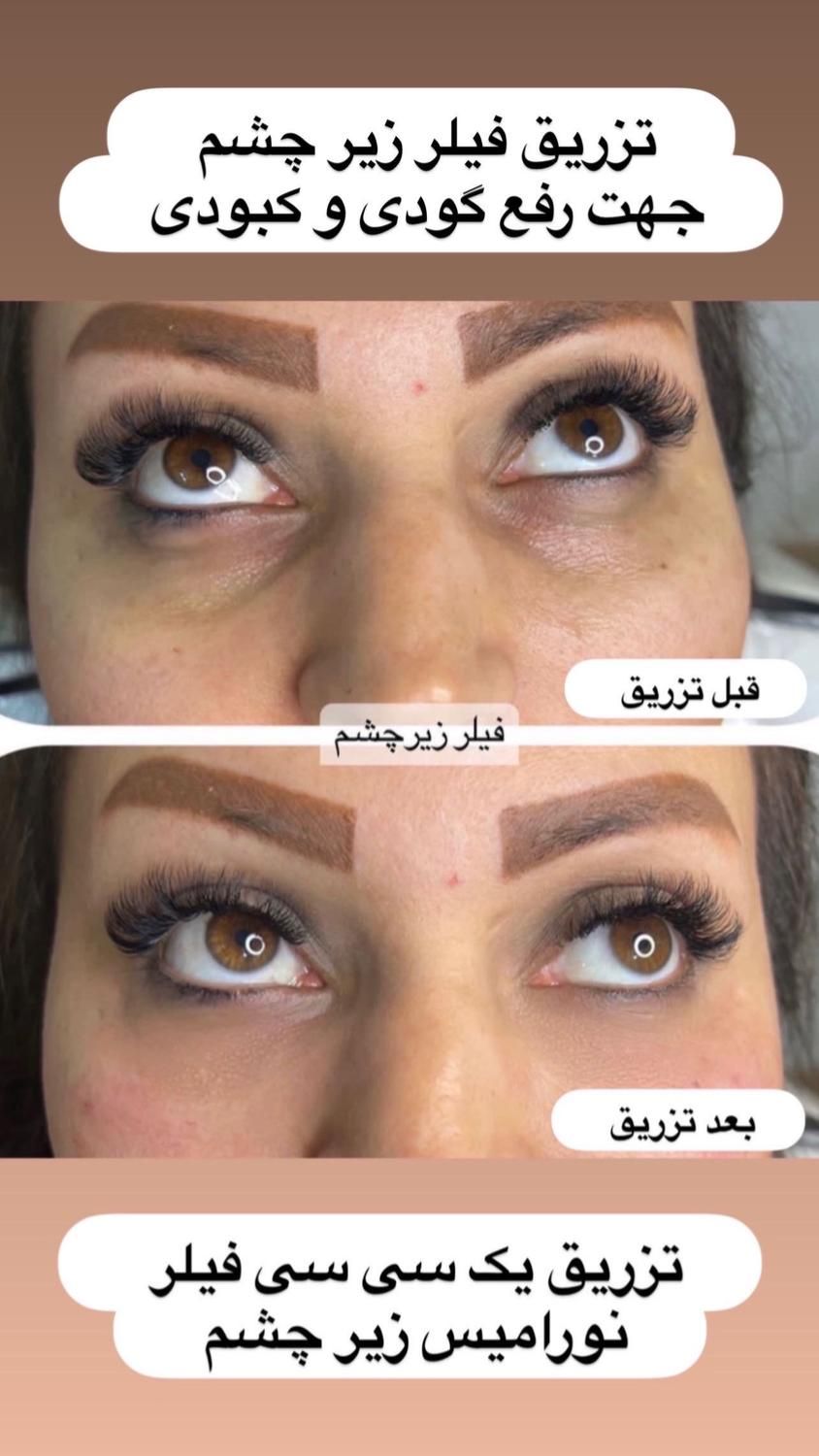 تزریق ژل بوتاکس لیفت نخ هایفو بلفاروپلاستی لیزر|خدمات آرایشگری و زیبایی|مشهد, کوه سنگی|دیوار