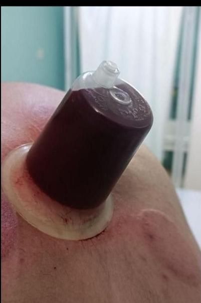 انجام و آموزش حجامت بانوان و آقایان|خدمات آرایشگری و زیبایی|خرمشهر, |دیوار