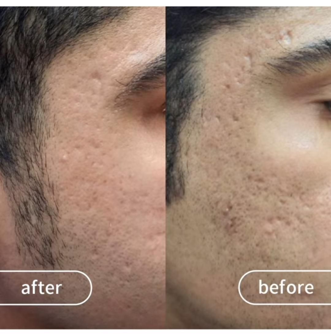 درمان همیشگی تورفتگی پوستی/ جای جوش/اسکار/سالک|خدمات آرایشگری و زیبایی|اصفهان, احمدآباد|دیوار