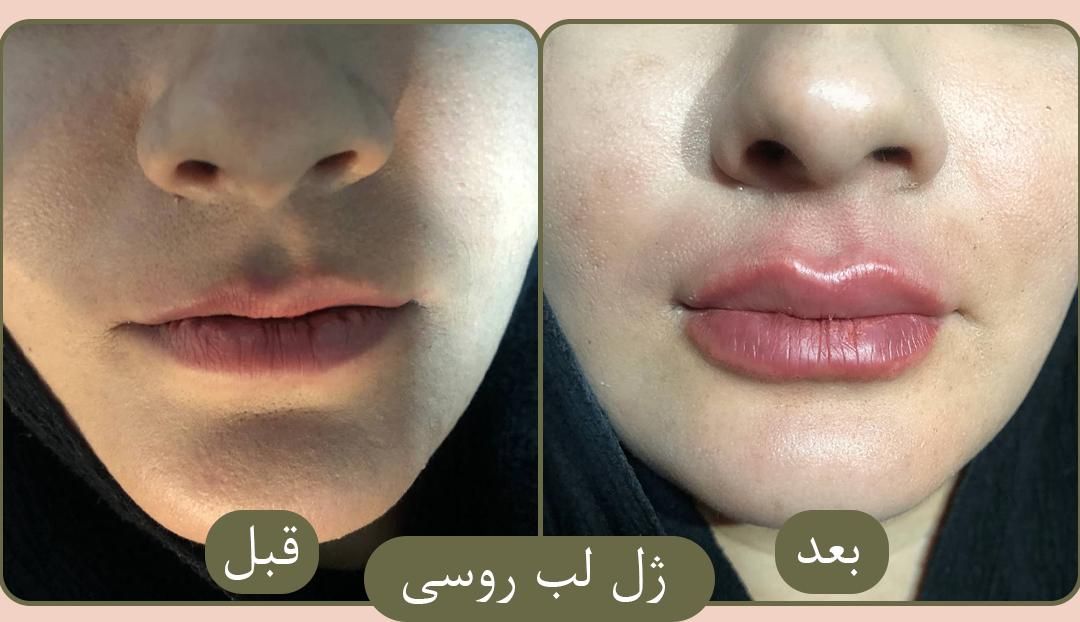 جشنواره بوتاکس،فیلر،‌لب روسی،جوانسازی،توسط پزشک|خدمات آرایشگری و زیبایی|زنجان, |دیوار