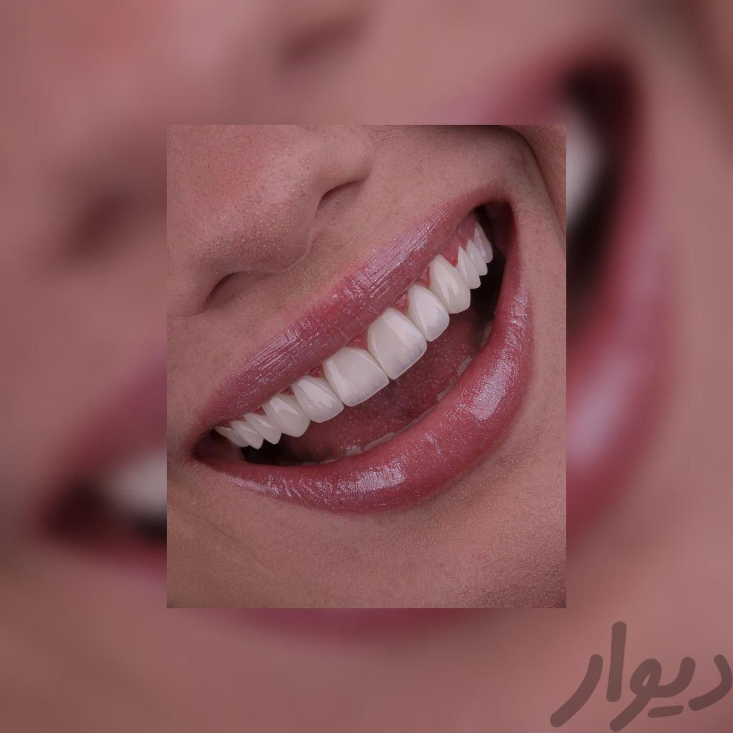 ایمپلنت و کامپوزیت و لمینت دندان|خدمات آرایشگری و زیبایی|تهران, میرداماد|دیوار