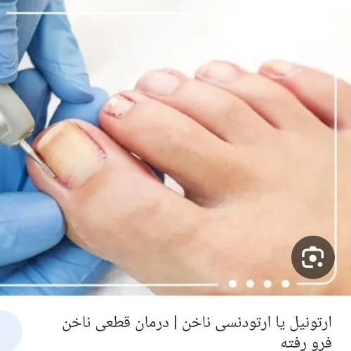 ارتونیل ناخن(ناخن فرورفته در گوشت) درمان عفونت|خدمات آرایشگری و زیبایی|اصفهان, طامه|دیوار