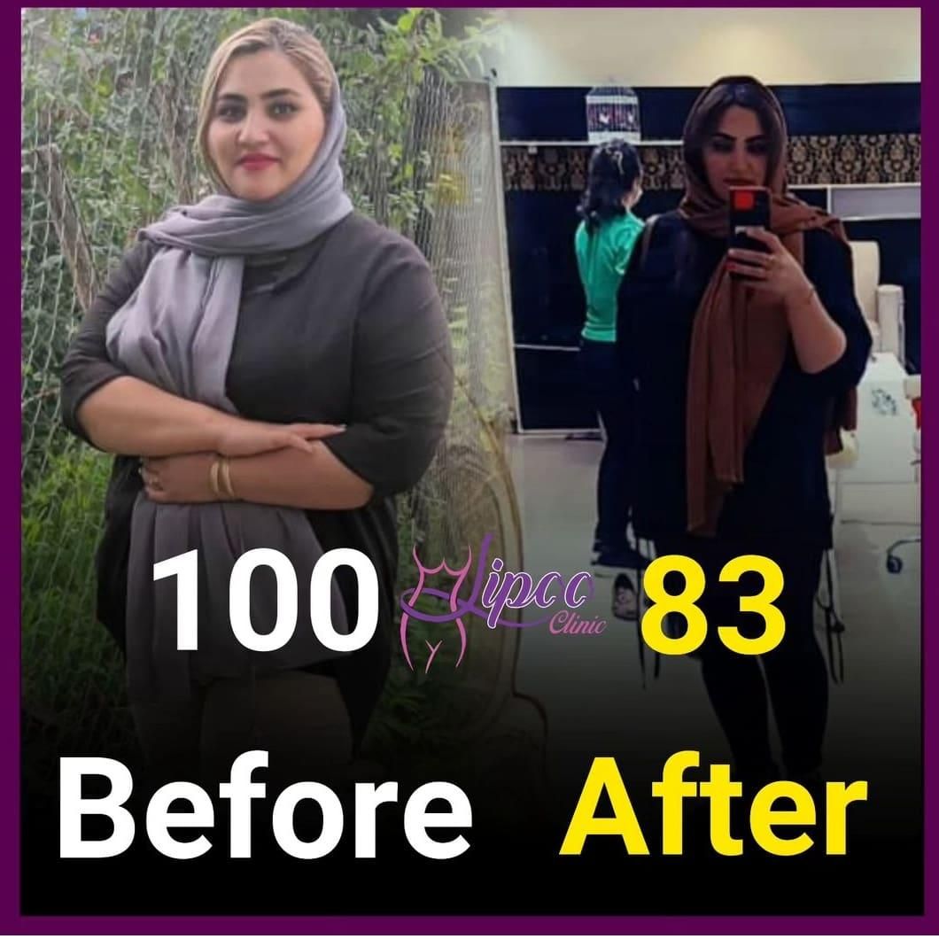 جراحی عمل اسلیومعده/اسلیو معده/چاقی لاغری/اسلیو|خدمات آرایشگری و زیبایی|تهران, چیتگر جنوبی|دیوار