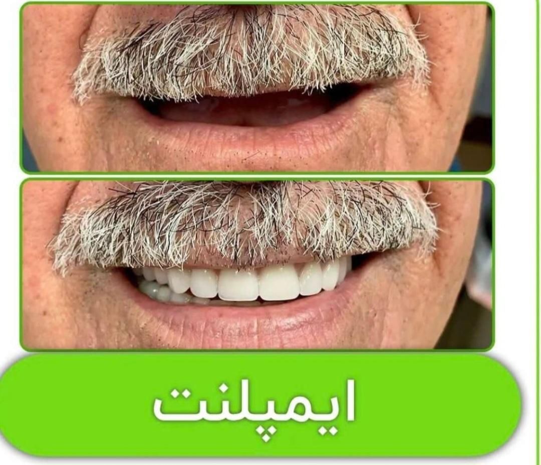مرکز تخصصی ایمپلنت، مطب دندانپزشکی باقیمتی کم نظیر|خدمات آرایشگری و زیبایی|شیراز, قصرالدشت|دیوار