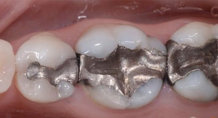 ضایعات آمالگام|آرایشی، بهداشتی، درمانی|شیراز, دینکان|دیوار