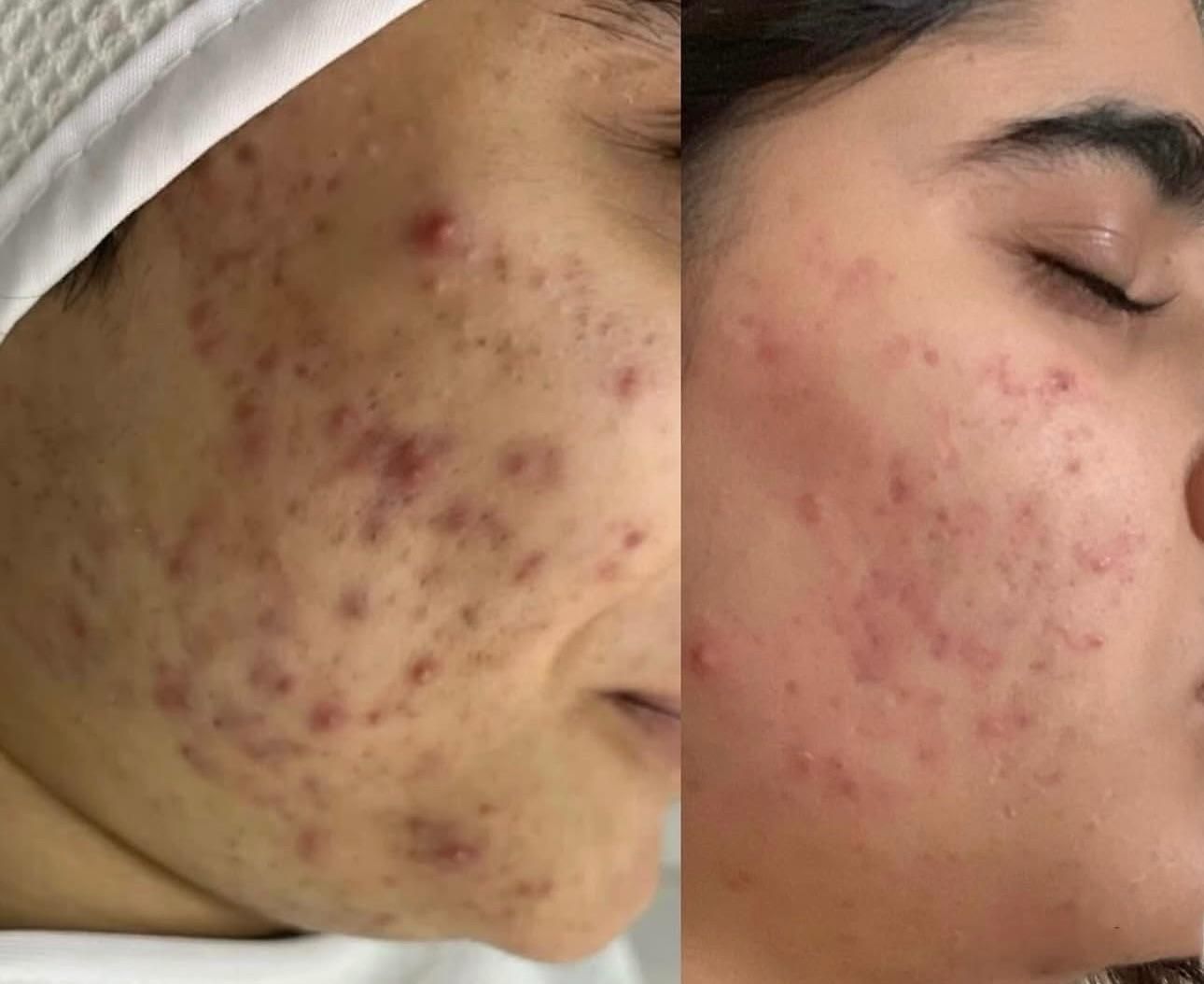کلینیک پوست/درمان لک/جوش جای جوش/مزونیدلینگ/فشیال|خدمات آرایشگری و زیبایی|مشهد, فرهنگ|دیوار