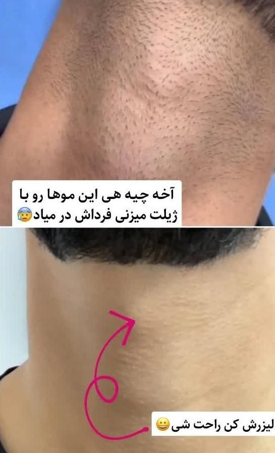 لیزر موهای زائد لیزر آقایان لیزر بانوان لیزر خانم|خدمات آرایشگری و زیبایی|اصفهان, سعادت‌آباد|دیوار