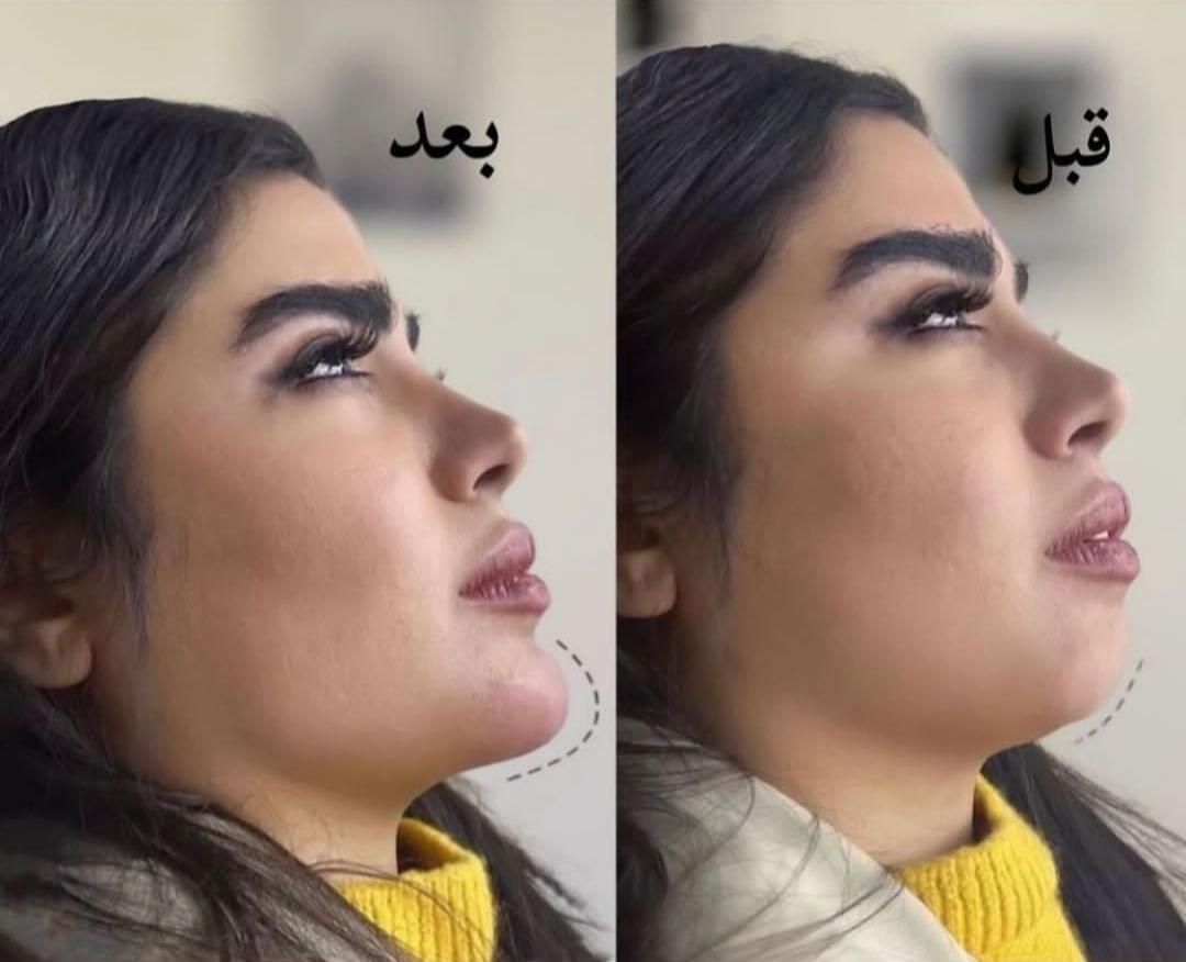 ژل لب بوتاکس لیزر فیلر هایفوبلفاروپلاستی|خدمات آرایشگری و زیبایی|مشهد, فرهنگ|دیوار