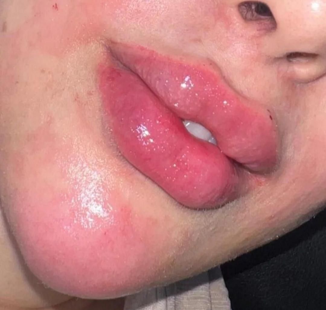 ژل لب و صورت بوتاکس|خدمات آرایشگری و زیبایی|رشت, گلسار|دیوار