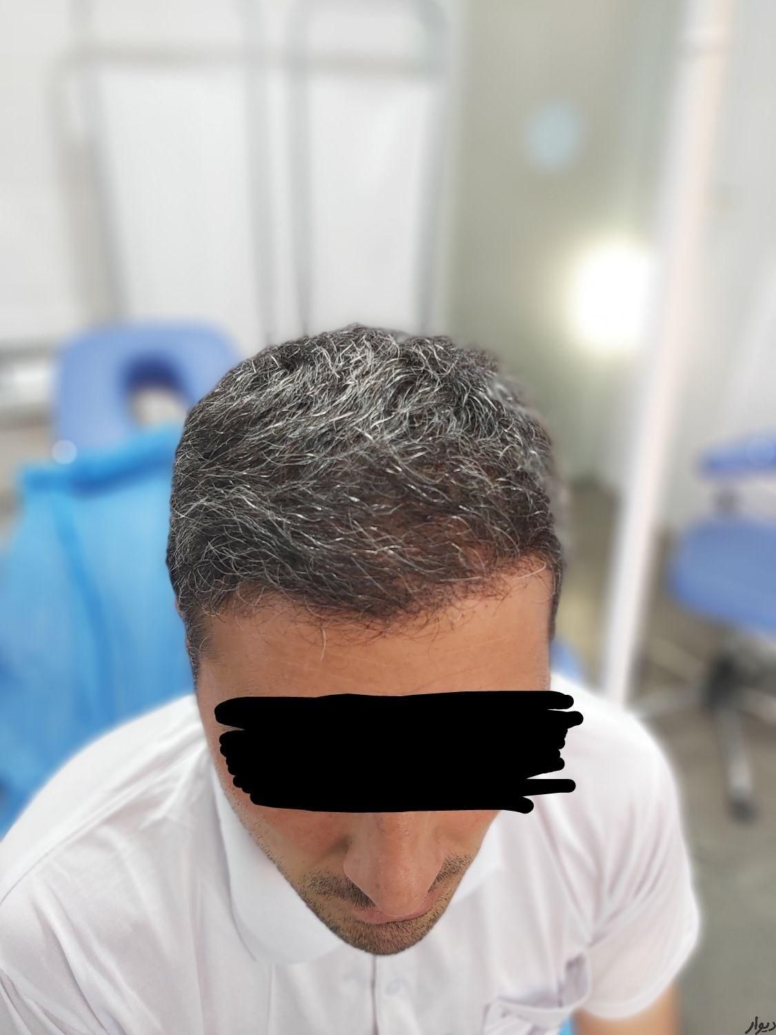 کاشت موی تخصصی و تضمینی|خدمات آرایشگری و زیبایی|تبریز, |دیوار