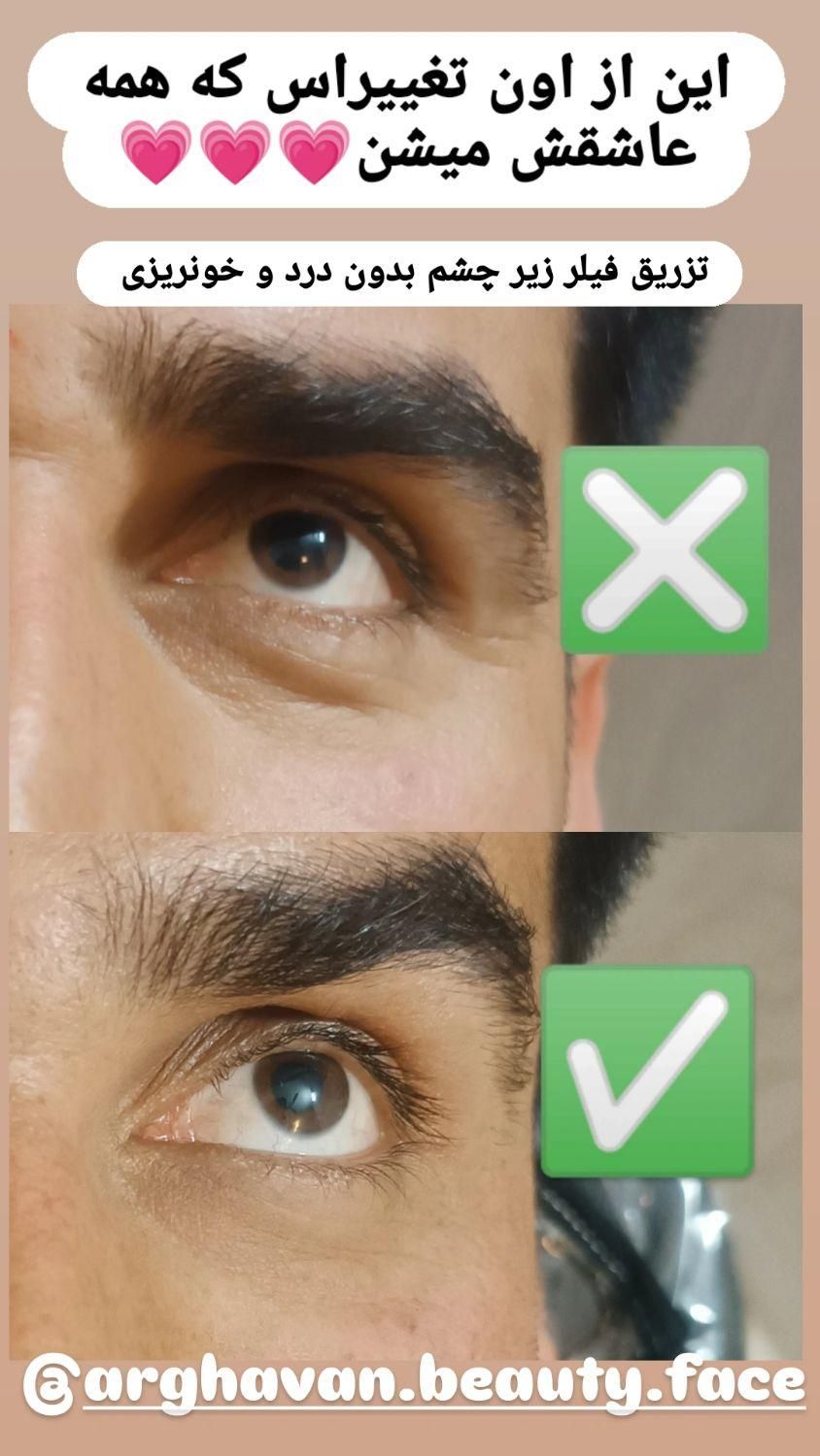 ژل و بوتاکس و آرایش دایم|خدمات آرایشگری و زیبایی|میبد, |دیوار