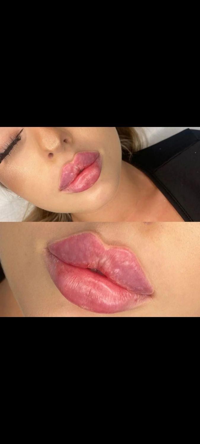 تزریق ژل بوتاکس،هایفو مزوتراپی توسط پزشک|خدمات آرایشگری و زیبایی|کرج, گوهردشت|دیوار