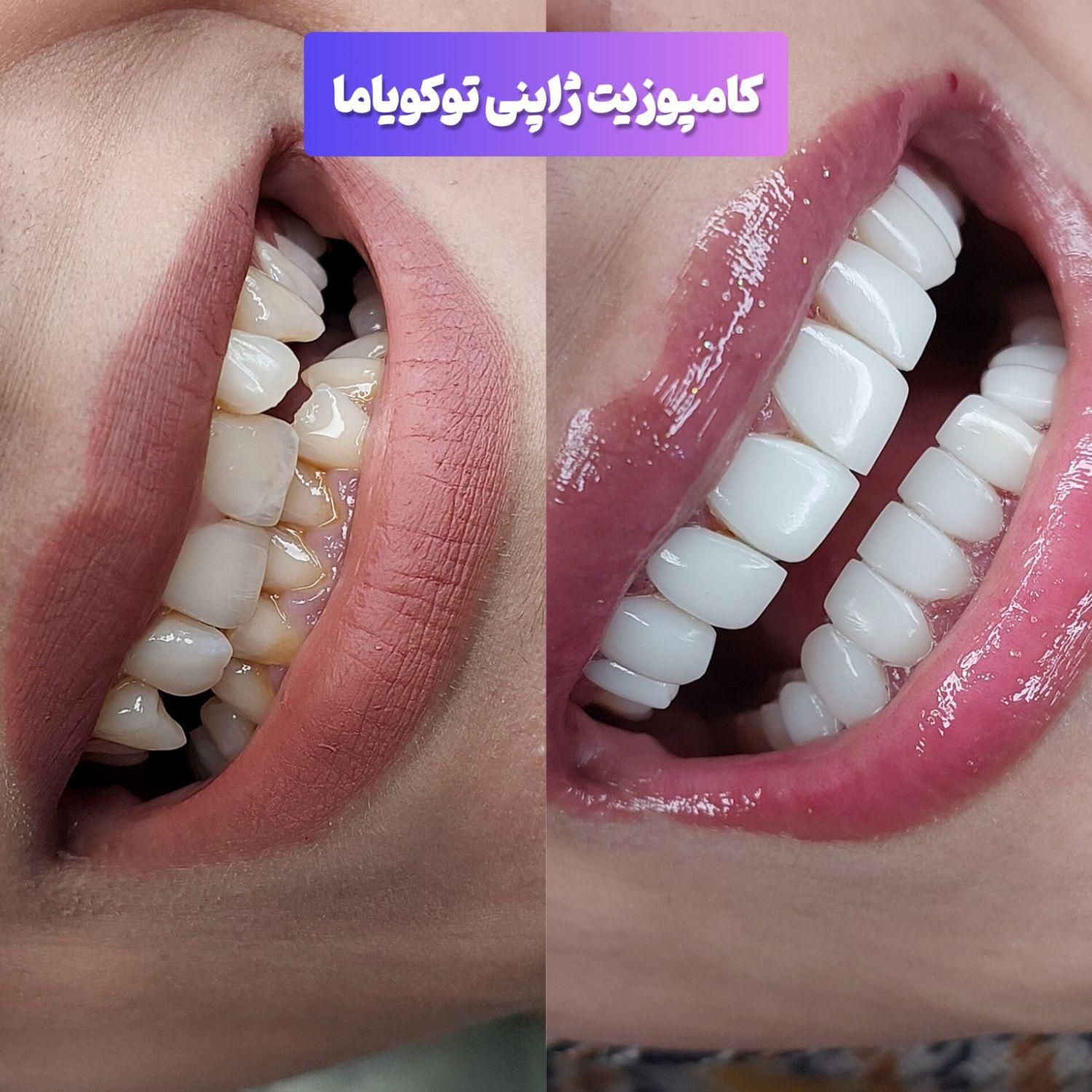 کامپوزیت،لمینیت،روکش،بلیچینگ در دندانپزشکی کیانمهر|خدمات آرایشگری و زیبایی|کرج, کیانمهر|دیوار