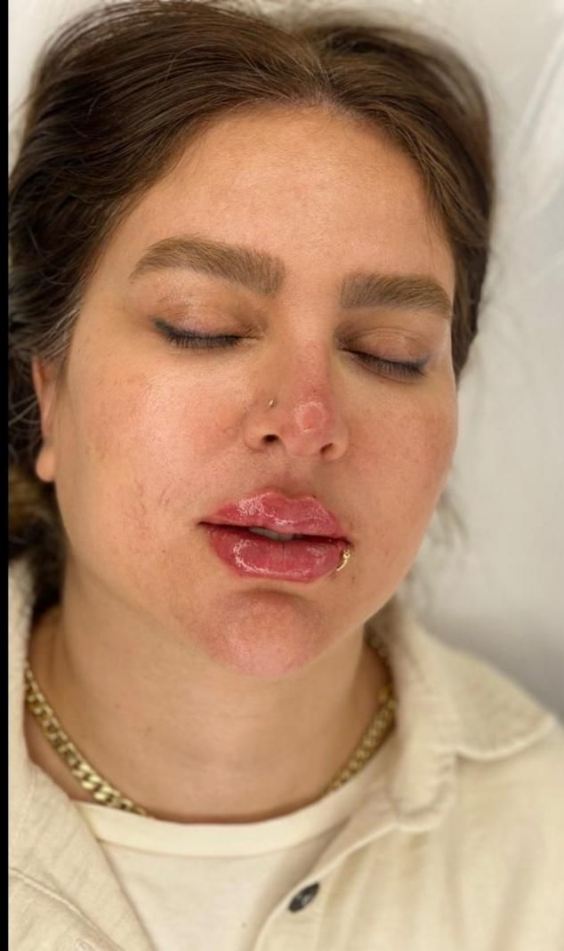 ژل لب و صورت بوتاکس|خدمات آرایشگری و زیبایی|رشت, گلسار|دیوار