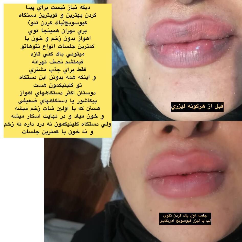 لیزر پاک کردن تاتو کیوسوییچ هایفوفرکشنالco2|خدمات آرایشگری و زیبایی|اهواز, کیانپارس |دیوار